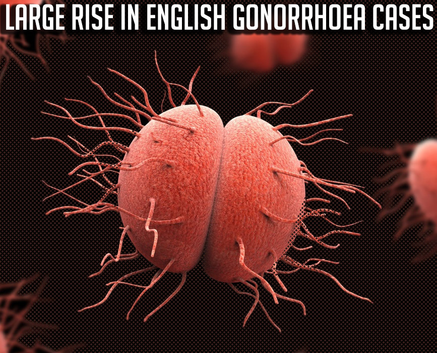 gonorrhoea in england title